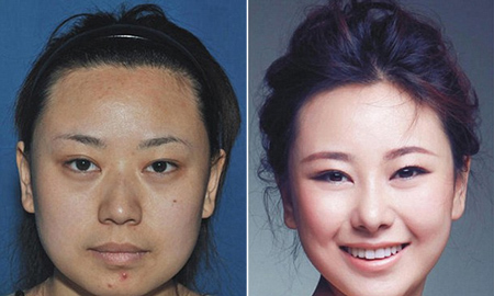 Xu hướng phẫu thuật thẩm mỹ làm đẹp của phụ nữ Trung Quốc